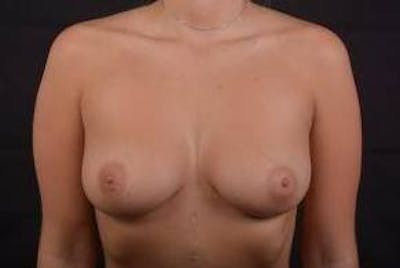 Immediate Breast Reconstruction – Nipple Sparing Before & After Gallery - Patient 292770 - Image 1