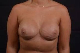 Immediate Breast Reconstruction – Nipple Sparing Before & After Gallery - Patient 292770 - Image 2