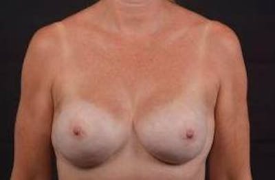 Immediate Breast Reconstruction – Nipple Sparing Before & After Gallery - Patient 113245 - Image 2