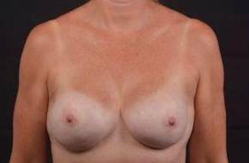 Immediate Breast Reconstruction – Nipple Sparing Before & After Gallery - Patient 113245 - Image 2