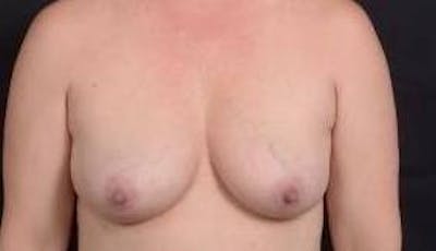 Immediate Breast Reconstruction – Nipple Sparing Before & After Gallery - Patient 112437 - Image 1