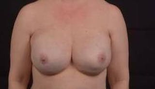Immediate Breast Reconstruction – Nipple Sparing Before & After Gallery - Patient 112437 - Image 2