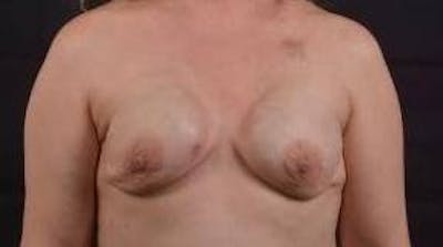 Immediate Breast Reconstruction – Nipple Sparing Before & After Gallery - Patient 199311 - Image 1