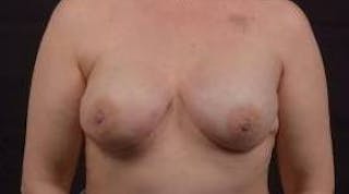 Immediate Breast Reconstruction – Nipple Sparing Before & After Gallery - Patient 199311 - Image 2
