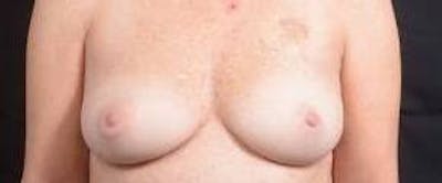 Immediate Breast Reconstruction – Nipple Sparing Before & After Gallery - Patient 280566 - Image 1