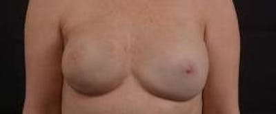 Immediate Breast Reconstruction – Nipple Sparing Before & After Gallery - Patient 280566 - Image 2
