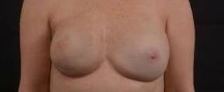 Immediate Breast Reconstruction – Nipple Sparing Before & After Gallery - Patient 280566 - Image 2