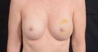 Immediate Breast Reconstruction – Nipple Sparing Before & After Gallery - Patient 148509 - Image 1