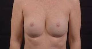 Immediate Breast Reconstruction – Nipple Sparing Before & After Gallery - Patient 148509 - Image 2