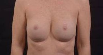 Immediate Breast Reconstruction – Nipple Sparing Before & After Gallery - Patient 148509 - Image 2