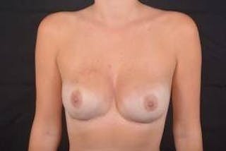 Immediate Breast Reconstruction – Nipple Sparing Before & After Gallery - Patient 201723 - Image 2