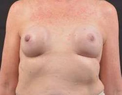 Immediate Breast Reconstruction – Nipple Sparing Before & After Gallery - Patient 118610 - Image 1
