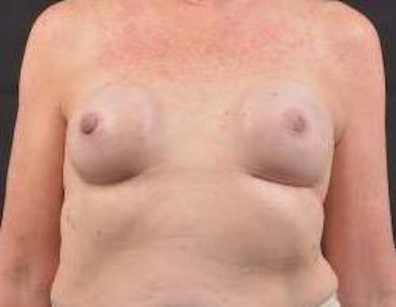 Immediate Breast Reconstruction – Nipple Sparing Before & After Gallery - Patient 118610 - Image 1