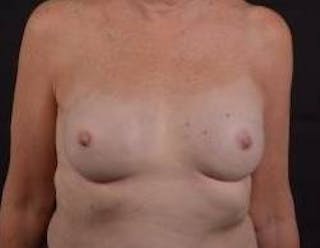 Immediate Breast Reconstruction – Nipple Sparing Before & After Gallery - Patient 118610 - Image 2