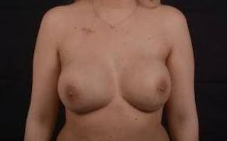 Immediate Breast Reconstruction – Nipple Sparing Before & After Gallery - Patient 125082 - Image 2