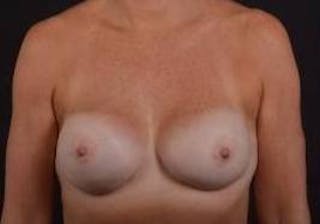 Immediate Breast Reconstruction – Nipple Sparing Before & After Gallery - Patient 290695 - Image 2