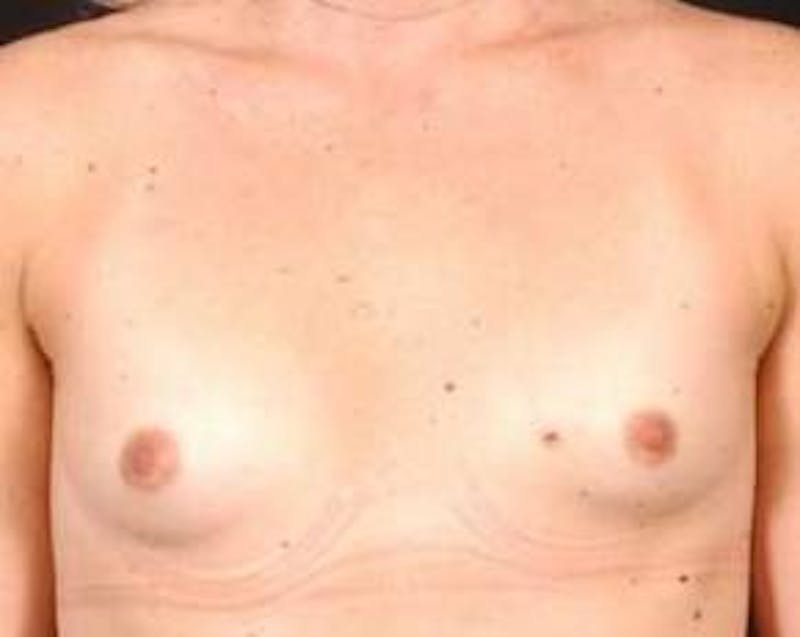 Immediate Breast Reconstruction – Nipple Sparing Before & After Gallery - Patient 116589 - Image 1
