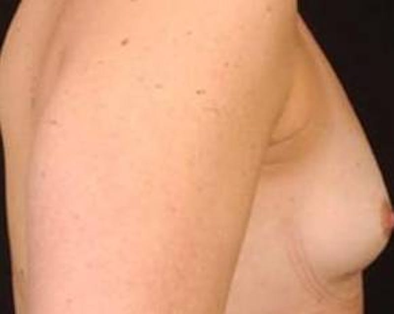 Immediate Breast Reconstruction – Nipple Sparing Before & After Gallery - Patient 116589 - Image 3