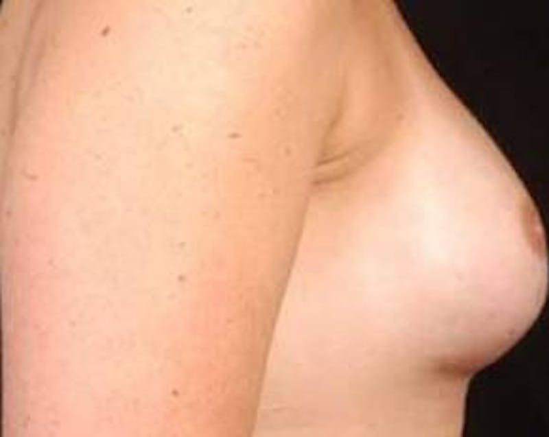 Immediate Breast Reconstruction – Nipple Sparing Before & After Gallery - Patient 116589 - Image 4