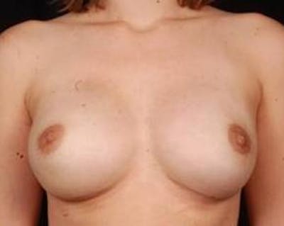 Immediate Breast Reconstruction – Nipple Sparing Before & After Gallery - Patient 378460 - Image 2
