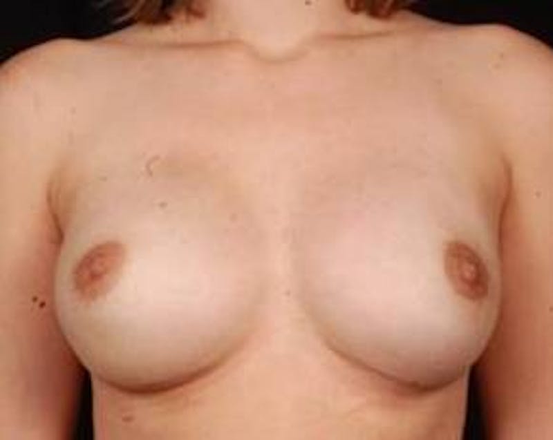 Immediate Breast Reconstruction – Nipple Sparing Before & After Gallery - Patient 378460 - Image 2