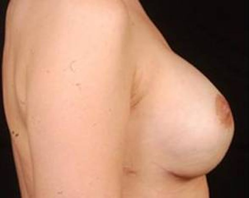 Immediate Breast Reconstruction – Nipple Sparing Before & After Gallery - Patient 378460 - Image 4