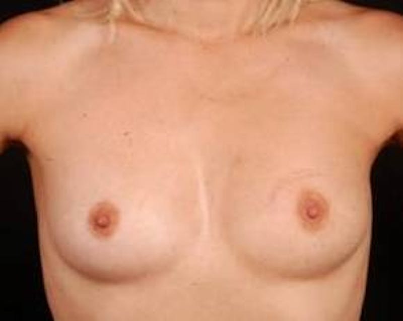 Immediate Breast Reconstruction – Nipple Sparing Before & After Gallery - Patient 126842 - Image 1