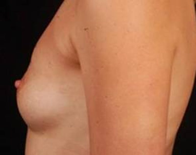 Immediate Breast Reconstruction – Nipple Sparing Before & After Gallery - Patient 126842 - Image 3