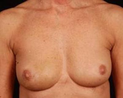 Immediate Breast Reconstruction – Nipple Sparing Before & After Gallery - Patient 143436 - Image 1