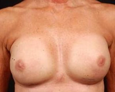 Immediate Breast Reconstruction – Nipple Sparing Before & After Gallery - Patient 143436 - Image 2