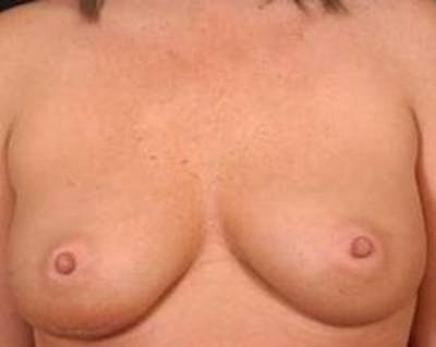Immediate Breast Reconstruction – Nipple Sparing Before & After Gallery - Patient 273584 - Image 1