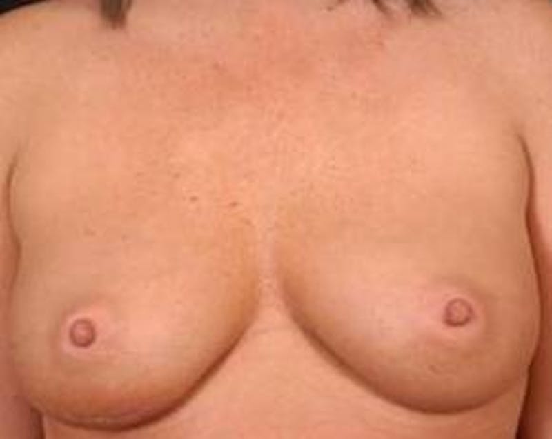 Immediate Breast Reconstruction – Nipple Sparing Before & After Gallery - Patient 273584 - Image 1
