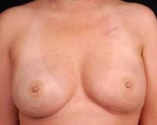Immediate Breast Reconstruction – Nipple Sparing Before & After Gallery - Patient 273584 - Image 2