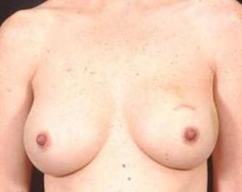 Immediate Breast Reconstruction – Nipple Sparing Before & After Gallery - Patient 160771 - Image 1