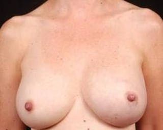 Immediate Breast Reconstruction – Nipple Sparing Before & After Gallery - Patient 160771 - Image 2