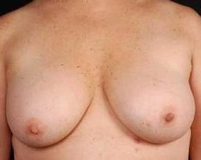 Immediate Breast Reconstruction – Nipple Sparing Before & After Gallery - Patient 350680 - Image 1