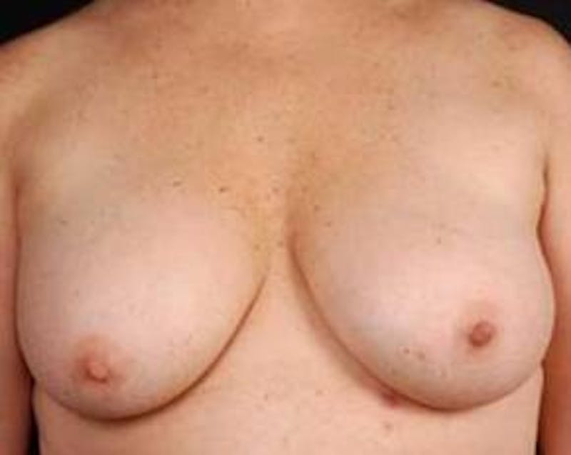 Immediate Breast Reconstruction – Nipple Sparing Before & After Gallery - Patient 350680 - Image 1