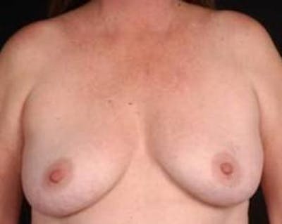 Immediate Breast Reconstruction – Nipple Sparing Before & After Gallery - Patient 155947 - Image 1
