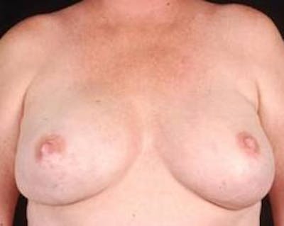Immediate Breast Reconstruction – Nipple Sparing Before & After Gallery - Patient 155947 - Image 2