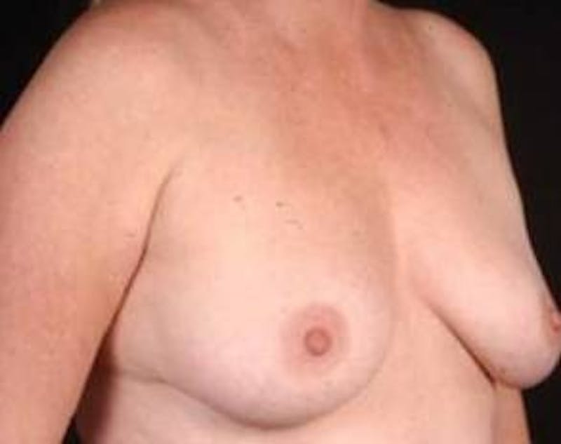 Immediate Breast Reconstruction – Nipple Sparing Before & After Gallery - Patient 155947 - Image 5