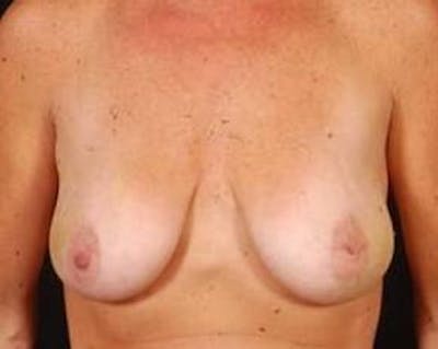 Immediate Breast Reconstruction – Nipple Sparing Before & After Gallery - Patient 333932 - Image 1