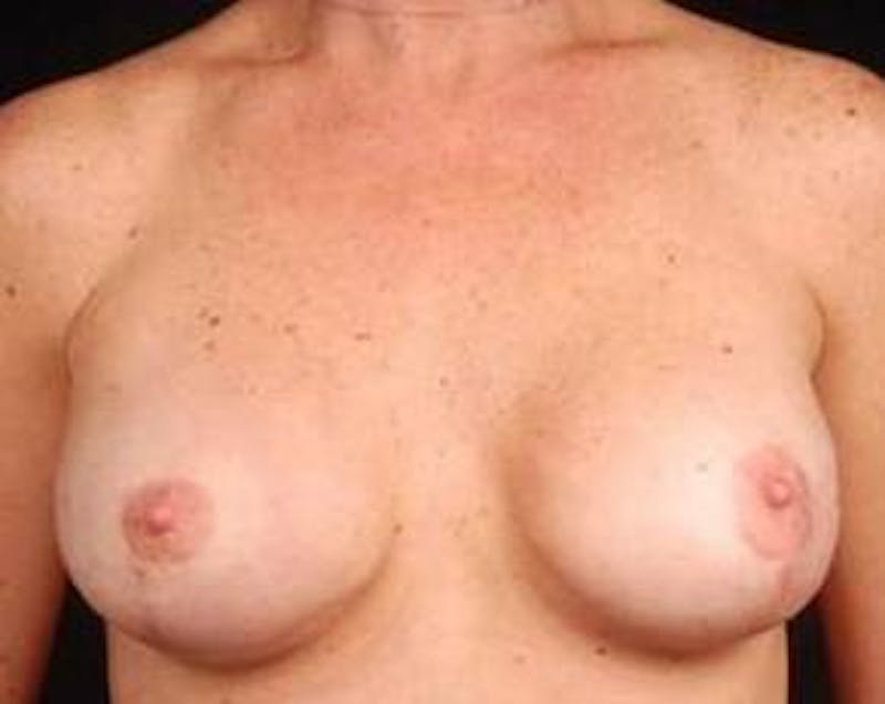 Immediate Breast Reconstruction – Nipple Sparing Before & After Gallery - Patient 333932 - Image 2