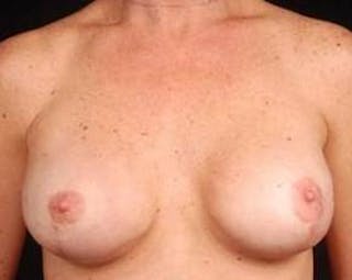 Immediate Breast Reconstruction – Nipple Sparing Before & After Gallery - Patient 333932 - Image 2