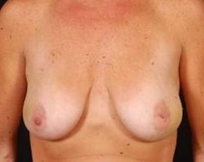Immediate Breast Reconstruction – Nipple Sparing Before & After Gallery - Patient 299235 - Image 1