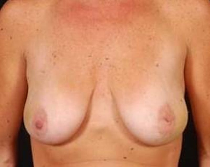 Immediate Breast Reconstruction – Nipple Sparing Before & After Gallery - Patient 299235 - Image 1