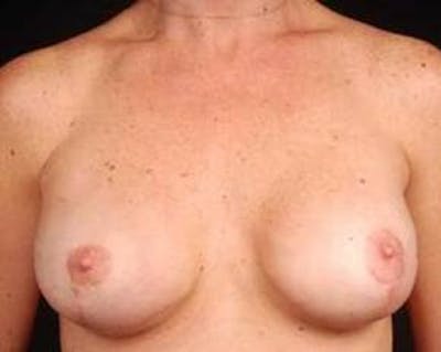 Immediate Breast Reconstruction – Nipple Sparing Before & After Gallery - Patient 299235 - Image 2