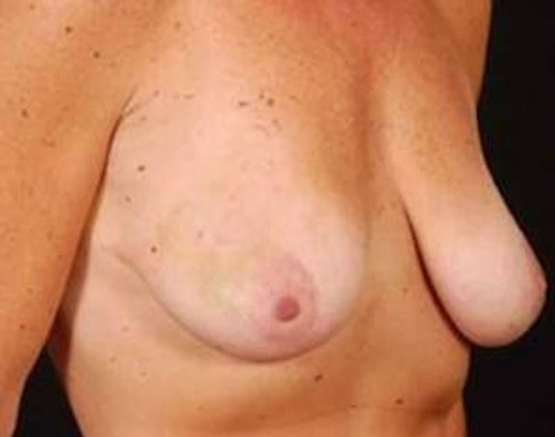 Immediate Breast Reconstruction – Nipple Sparing Before & After Gallery - Patient 299235 - Image 5