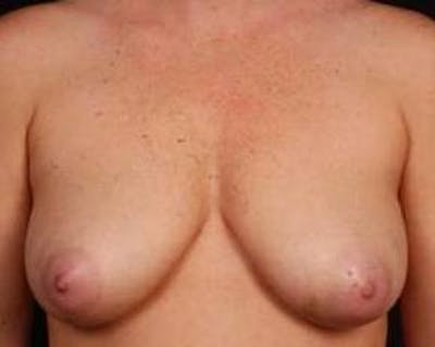 Immediate Breast Reconstruction – Nipple Sparing Before & After Gallery - Patient 567938 - Image 1
