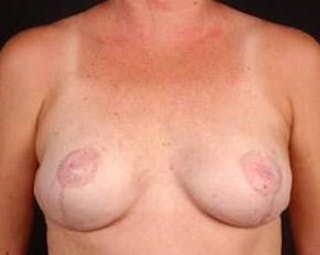 Immediate Breast Reconstruction – Nipple Sparing Before & After Gallery - Patient 567938 - Image 2