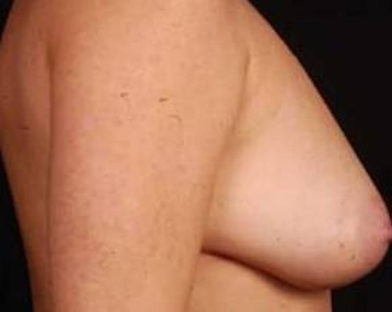 Immediate Breast Reconstruction – Nipple Sparing Before & After Gallery - Patient 567938 - Image 3